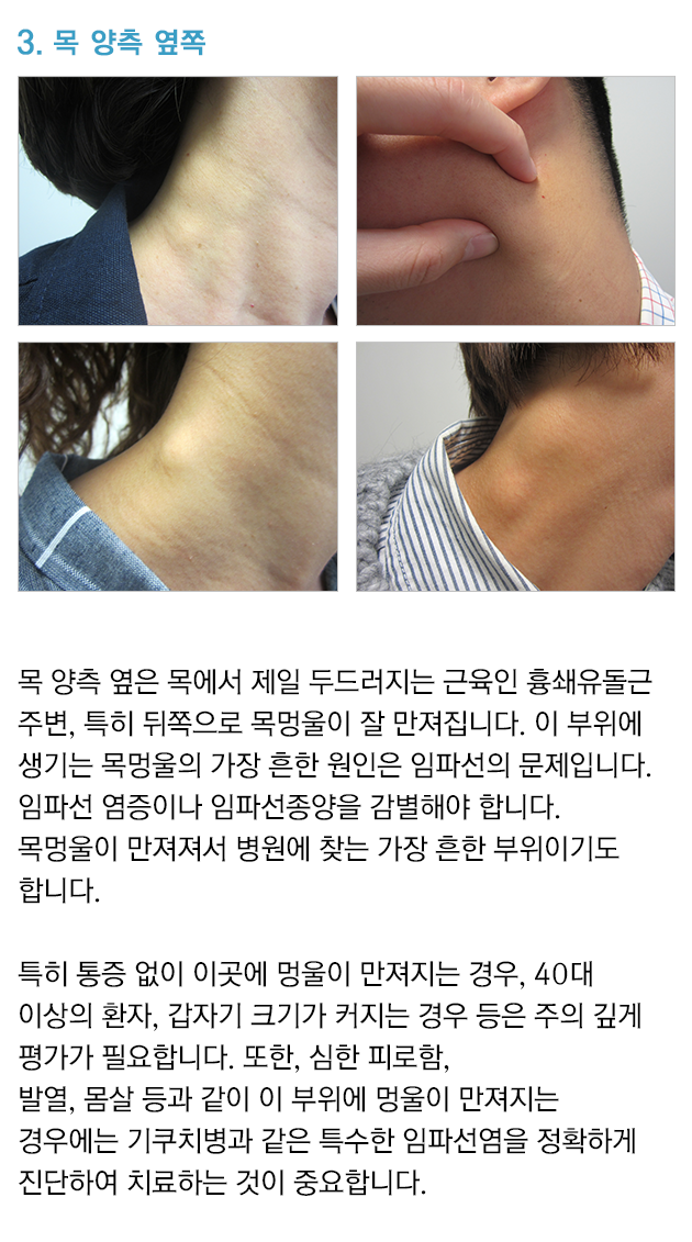 목 멍울이 생긴 위치에 따른 질환 종류 - 목 양측 옆쪽 